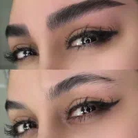 میکروبلیدینگ،فیبروز کرکی مویی