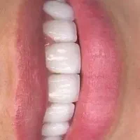 کامپوزیت دندان تخفیف ویژه روکش دندانپزشکی تهرانسر|خدمات آرایشگری و زیبایی|تهران, تهرانسر مرکزی|دیوار