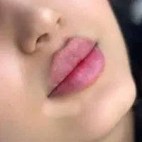 جشنواره ژل و بوتاکس