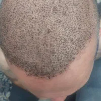 کاشت مو طبیعی تراکم بالا