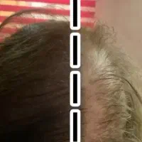 ۴۰ درصد تخفیف میکرواسکالپ سر در رشت و تنکابن