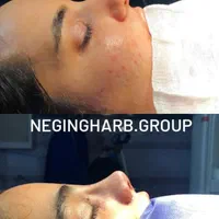 عمل بینی با هزینه بیمارستان ۴۵م (تمام جراحی ها)|خدمات آرایشگری و زیبایی|تهران, سعادت‌آباد|دیوار