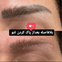 پاک کردن تتو/کربن تراپی/هایفو/بوتاکس وژل/لاغری