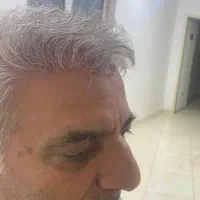 کاشت مو 12 ملیون با ضمانت|خدمات آرایشگری و زیبایی|تبریز, |دیوار