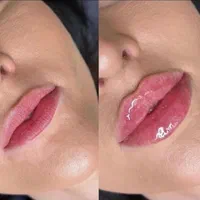 ژل لب چونه گونه زاویه بوتاکس prp لیزر مو بدن هایفو|خدمات آرایشگری و زیبایی|کرج, گوهردشت|دیوار