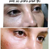 ۲۰ درصد تخفیف خدمات ژل و بوتاکس|خدمات آرایشگری و زیبایی|دوگنبدان, |دیوار