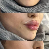 تخفیفات 15 درصدی فیشال ژل و بوتاکس در کلینیک رازیل