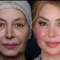 تزریق ژل وبوتاکس ۷۹۰. مید فیس ۴۵۰۰توسط پزشک مجرب