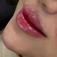 تزریق فیلر،بوتاکس،مزو،میکرو،سابسیژن