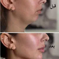 خدمات ژل و بوتاکس و مزوتراپی ، جوانسازی