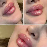 کربن تراپی کربوکسی پی آرپی مزو تراپی هایفو لاغری