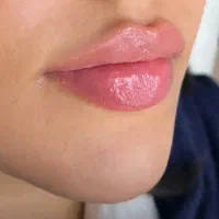 حجم دهنده لب دائمی(بدون تزریق)