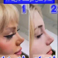 عمل بینی۲۰ میلیون قسطی با شرایط فوق العاده عالی|خدمات آرایشگری و زیبایی|مشهد, احمدآباد|دیوار