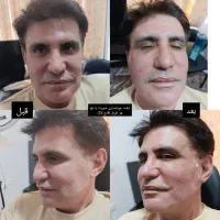 لیفت وجوانسازی با نخ های کاگ و تزریق فیلر ومزوها|خدمات آرایشگری و زیبایی|شیراز, میانرود|دیوار