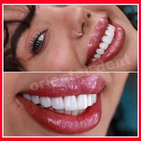 کامپوزیت دندان/لمینیت/دندانپزشکی/ترمیم/عصبکشی