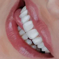 کامپوزیت، عصب کشی، پرکردن، ایمپلنت دندان قسط.ی