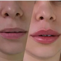 کلینیک پوست و زیبایی   ژل لب/فیلرگونه/زاویه/بوتاکس|خدمات آرایشگری و زیبایی|قم, صفائیه|دیوار