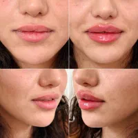مدل تزریقات زیبایی