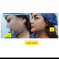 اندولیفت.لیپوفیس.ساکشن غبغب با اولترا زد|خدمات آرایشگری و زیبایی|مشهد, سناباد|دیوار