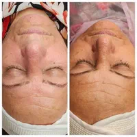 وقت مراقبت از پوستته(پاکسازی،پلاژن تراپی اسیدتراپی|خدمات آرایشگری و زیبایی|بابل, |دیوار