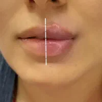 جشنواره50%تزریق ژل بوتاکس لیزرزاویه مانجارو کلینیک