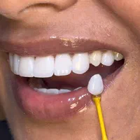 ونیر- عصب کشی دندان و ترمیم دندان- روکش-جرم گیری