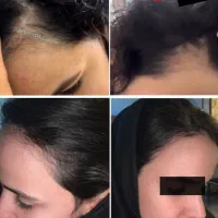 مشاوره ریزش مو