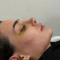 عمل زیبایی بینی و پلک/لیفت صورت با تعرفه ۱۴۰۴