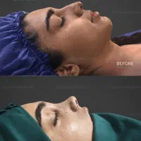 جشنواره زیبایی عمل بینی رینوپلاستی سیما سرچشمه|خدمات زیبایی و سلامت|اردبیل, |دیوار