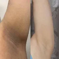 سفیدکردن‌نواحی تیره بدن