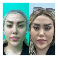 ساکشن غبغب،جراحی بلفاروپلاستی|خدمات آرایشگری و زیبایی|شهرکرد, |دیوار