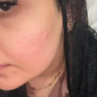 درمان جوش با هر منشایی|خدمات آرایشگری و زیبایی|دوگنبدان, |دیوار