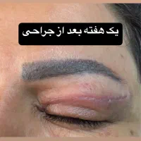 بلفاروپلاستی پلک با روش لیزری بدون رد بخیه|خدمات آرایشگری و زیبایی|تهران, پاسداران|دیوار