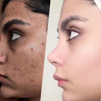 مدل پاکسازی صورت و فیشیال فوری فقط هزینه مواد|خدمات آرایشگری و زیبایی|اهواز, پردیس دو|دیوار