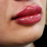 ژل وبوتاکس|خدمات آرایشگری و زیبایی|قم, شهرک فاطمیه|دیوار