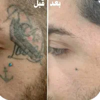 لیزر تتو  و کیوسوییچ با بهترین دستگاه خوزستان