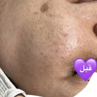 پاکسازی و فیشیال تخصصی و خال برداشتن