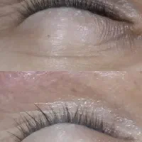 (فیشال )پاکسازی تخصصی پوست