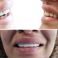 لمینت متحرک دندان|آرایشی، بهداشتی، درمانی|زابل, |دیوار