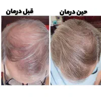 بهبود کبدچرب و معده