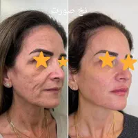 ژل لب و چانه و بوتاکس و نخ و لیزر و لیزر موهای بدن|خدمات آرایشگری و زیبایی|تهران, آذربایجان|دیوار
