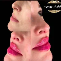 جشنواره ژل و بوتاکس و مزوژل