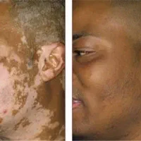 درمان پیسی با روش طب نوین گیاهی