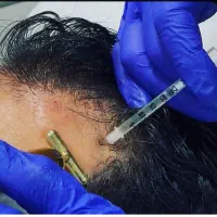 مزوتراپی مو (قطع ریزش)|خدمات آرایشگری و زیبایی|اندیشه, اندیشه فاز ۳|دیوار