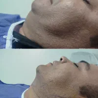 جراحی بلفارو پلاستی ساکشن غبغب بوکال فت سانترال .|خدمات آرایشگری و زیبایی|کرج, فاز ۳ مهرشهر|دیوار