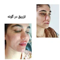 تزریق ژل لب،تزریق ژل گونه ،تزریق ژل چانه، بوتاکس|خدمات آرایشگری و زیبایی|ساری, |دیوار