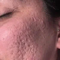 مدل برای درمان مشکلات پوستی (دستمزدرایگان)