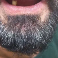 دندانسازی (دندان مصنوعی)پروتز متحرک|خدمات آرایشگری و زیبایی|قم, شاه ابراهیم|دیوار