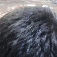 راهنمایی جهت کاشت موی سر