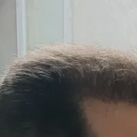 کاشت مو باضمانتنامه کتبی مادام العمر|خدمات آرایشگری و زیبایی|تبریز, |دیوار